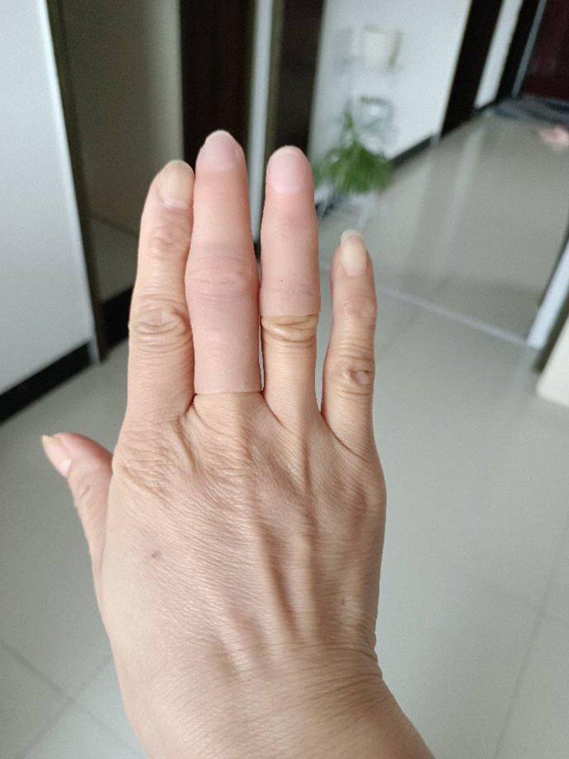 假手指：个性化定制与材料革新